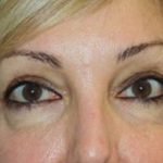 Eye Lid Lift Before & After Patient #5762