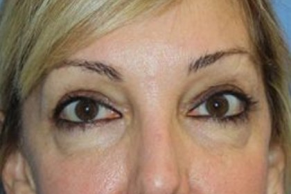 Eye Lid Lift Before & After Patient #5762