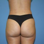 Brazilian Butt Lift Before & After Patient #5578