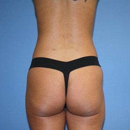 Brazilian Butt Lift Before & After Patient #5578