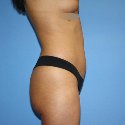 Brazilian Butt Lift Before & After Patient #5578