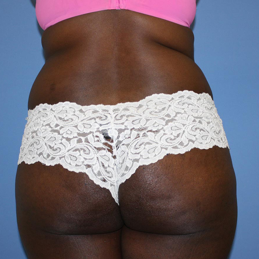 Brazilian Butt Lift Before & After Patient #5581