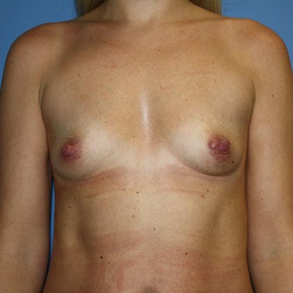 Breast Augmentation Before & After Patient #5588