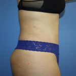 Tummy Tuck Before & After Patient #5623