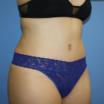 Tummy Tuck Before & After Patient #5623