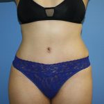 Tummy Tuck Before & After Patient #5623