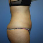 Tummy Tuck Before & After Patient #5623