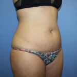 Tummy Tuck Before & After Patient #5623