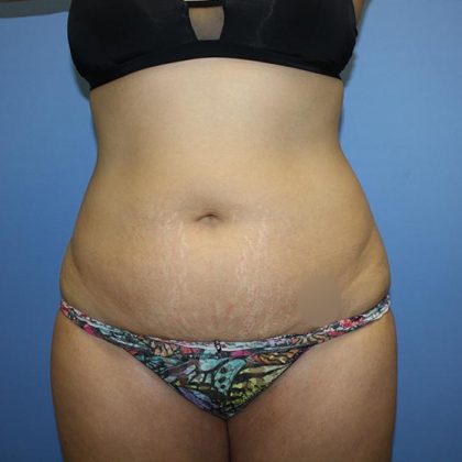Tummy Tuck Before & After Patient #5623