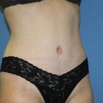 Tummy Tuck Before & After Patient #5663