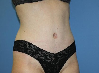 Tummy Tuck Before & After Patient #5663