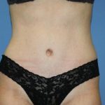 Tummy Tuck Before & After Patient #5663