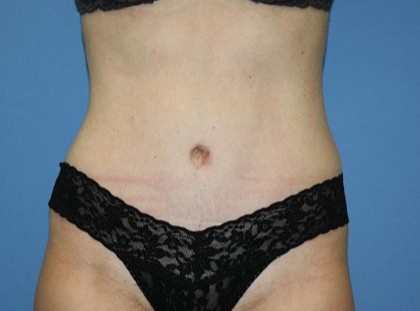 Tummy Tuck Before & After Patient #5663