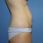 Tummy Tuck Before & After Patient #5663