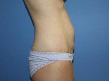 Tummy Tuck Before & After Patient #5663
