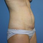 Tummy Tuck Before & After Patient #5663