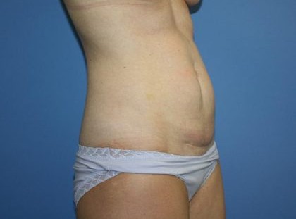 Tummy Tuck Before & After Patient #5663