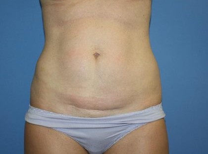 Tummy Tuck Before & After Patient #5663