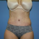 Tummy Tuck Before & After Patient #5666