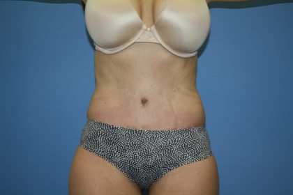 Tummy Tuck Before & After Patient #5666