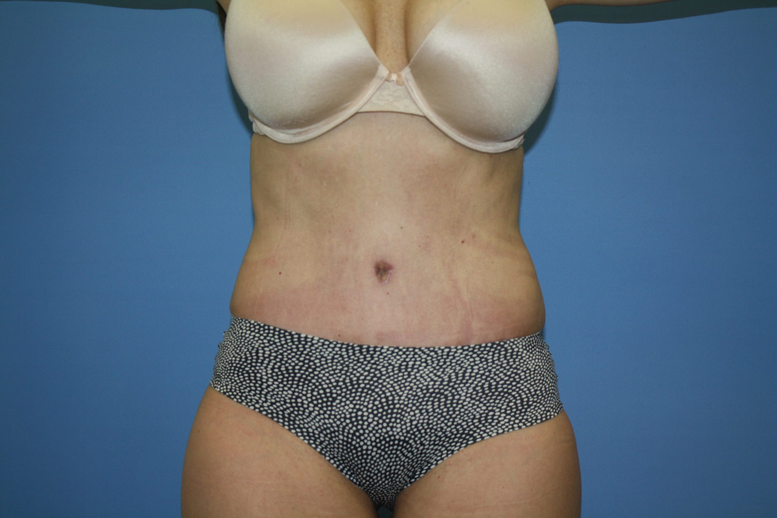 Tummy Tuck Before & After Patient #5666