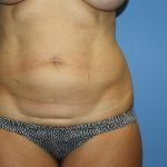 Tummy Tuck Before & After Patient #5666