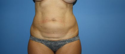 Tummy Tuck Before & After Patient #5666