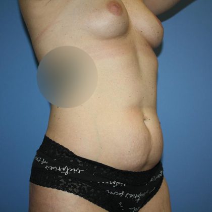 Tummy Tuck Before & After Patient #6674