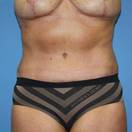 Tummy Tuck Before & After Patient #5605