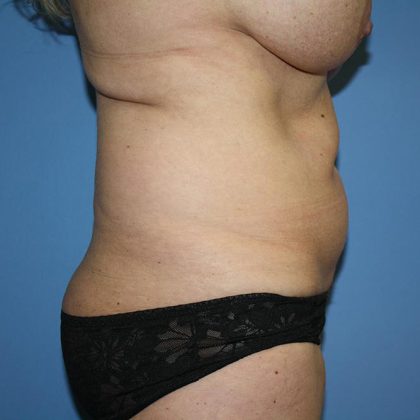 Tummy Tuck Before & After Patient #5605