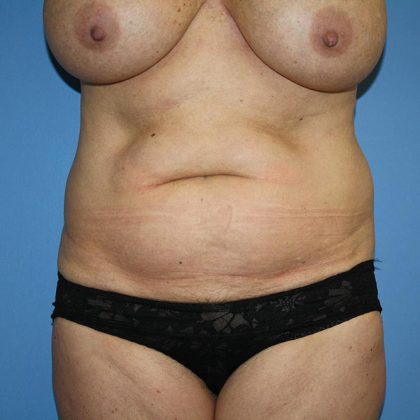 Tummy Tuck Before & After Patient #5605