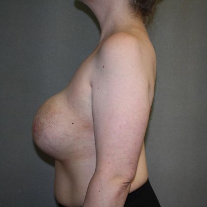 Breast Lift with Implant Before & After Patient #5638