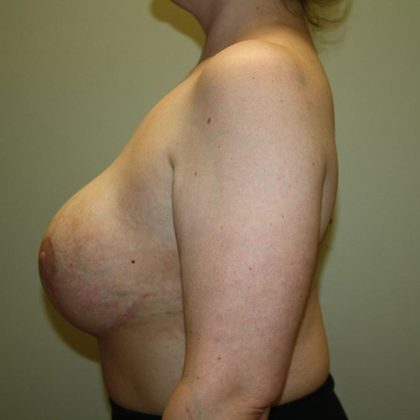 Breast Lift with Implant Before & After Patient #5638