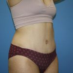 Tummy Tuck Before & After Patient #5644