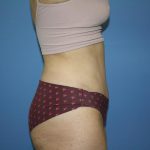 Tummy Tuck Before & After Patient #5644