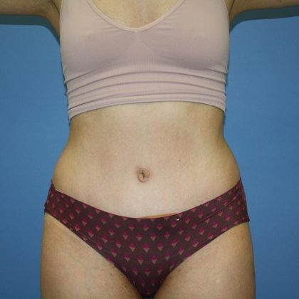 Tummy Tuck Before & After Patient #5644