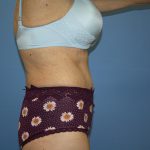 Tummy Tuck Before & After Patient #5691