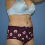 Tummy Tuck Before & After Patient #5691