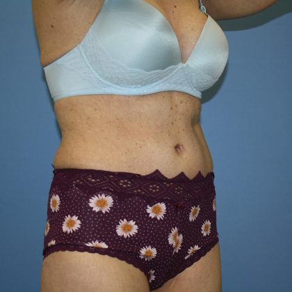 Tummy Tuck Before & After Patient #5691