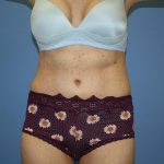 Tummy Tuck Before & After Patient #5691