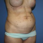 Tummy Tuck Before & After Patient #5691