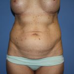 Tummy Tuck Before & After Patient #5691