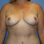 Breast Lift Before & After Patient #5746