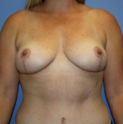 Breast Lift Before & After Patient #5746