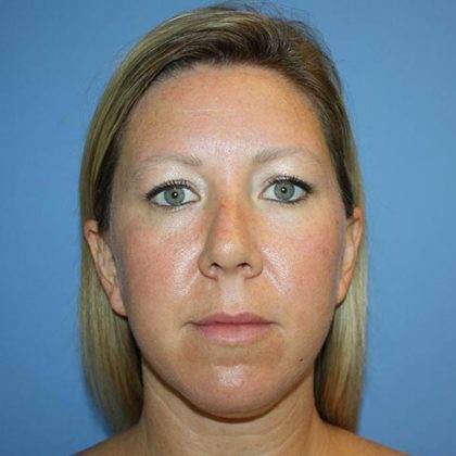 Nose Surgery Before & After Patient #5744