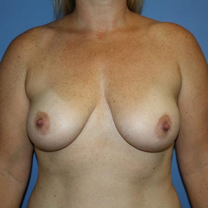 Breast Lift Before & After Patient #5746