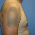 Gynecomastia Before & After Patient #7354