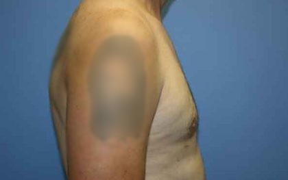 Gynecomastia Before & After Patient #7354