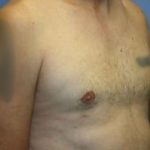Gynecomastia Before & After Patient #7354