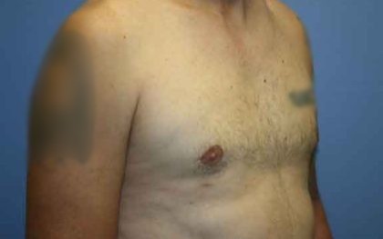 Gynecomastia Before & After Patient #7354